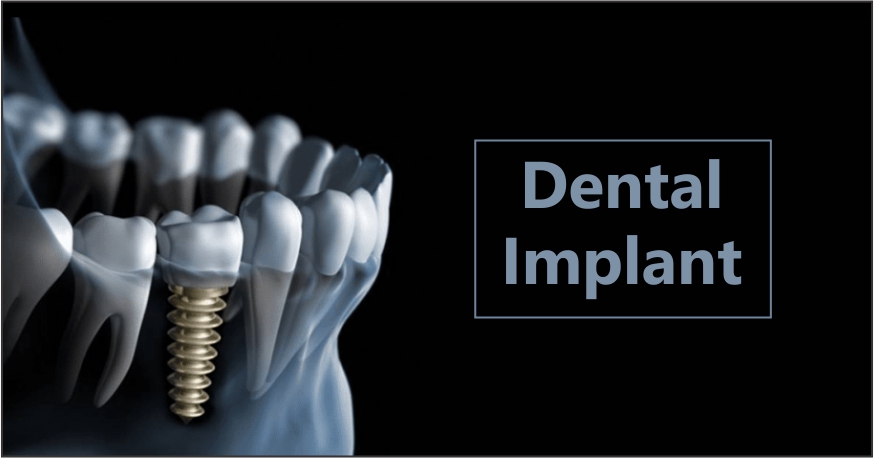 Dental Implants