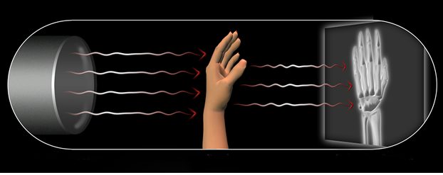 Radiation dose in xray