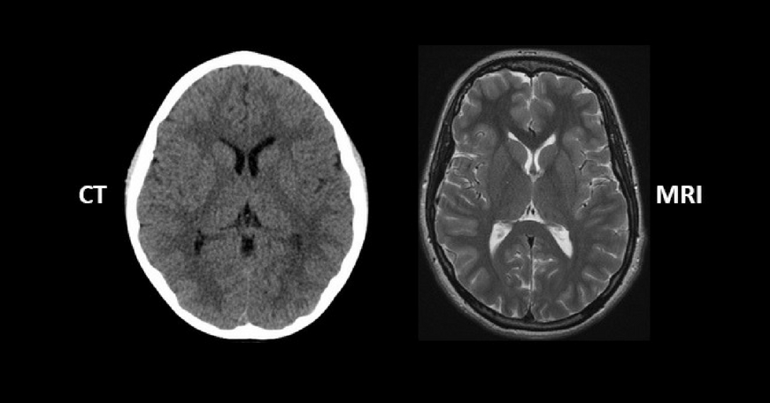 ct scan vs MRI