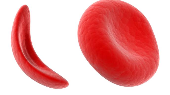 Sickle Cell Disorder