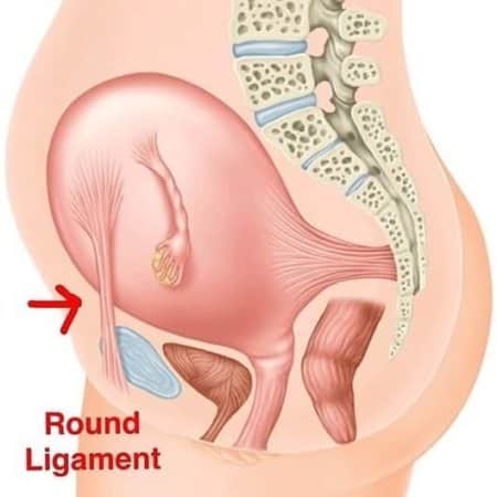 Round ligament pain