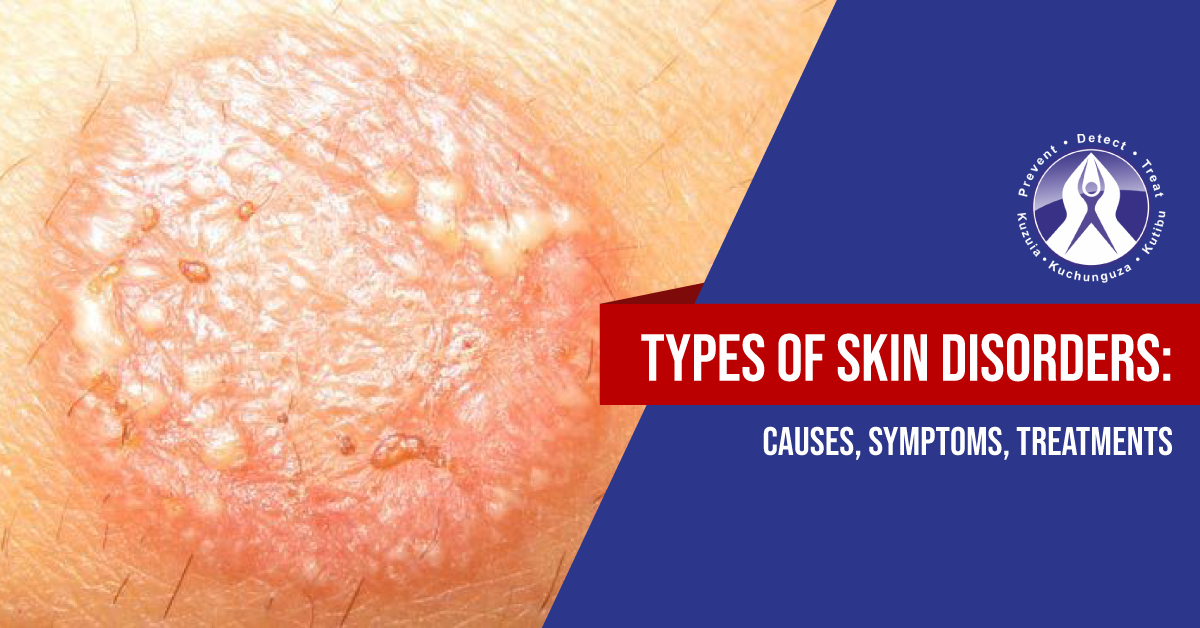 Skin Disorders Eczema Scabies Tinea Corporis Regency Medical Centre