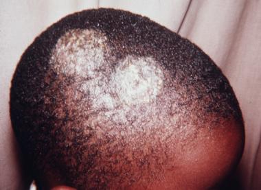 Skin Disorders Tinea Capitis