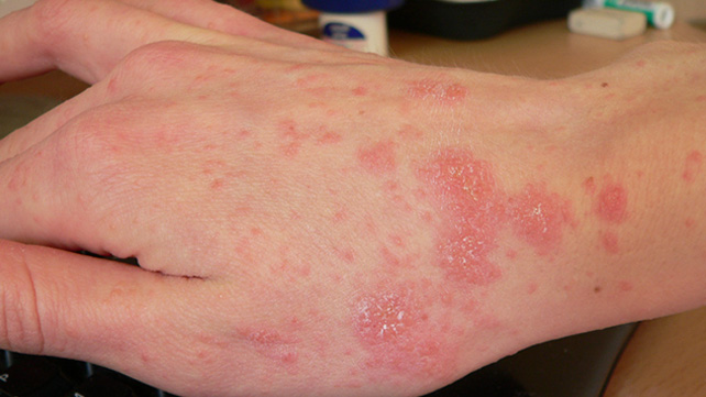 Skin Disorders Scabies