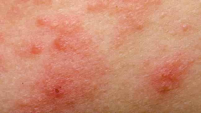 Skin Disorders Eczema