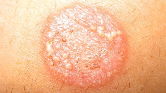 Skin Disorders Tinea Corporis (Ringworm)