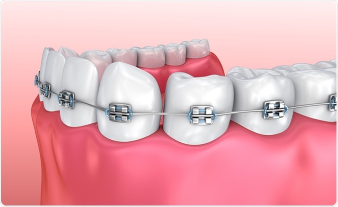 Metal-braces