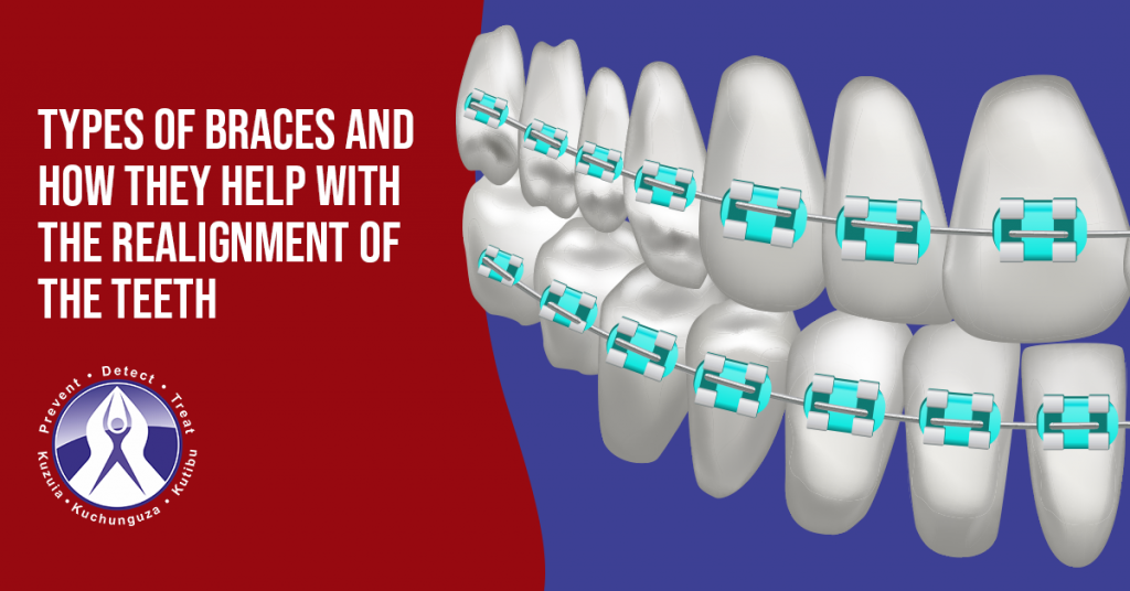 Types of Braces and How They Help With the Realignment of the Teeth