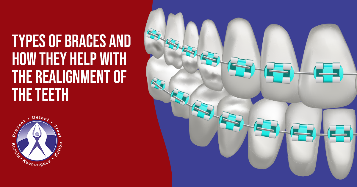 Types of Braces