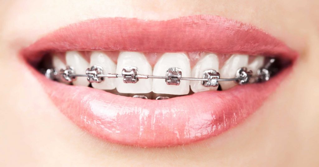 self-ligating-braces