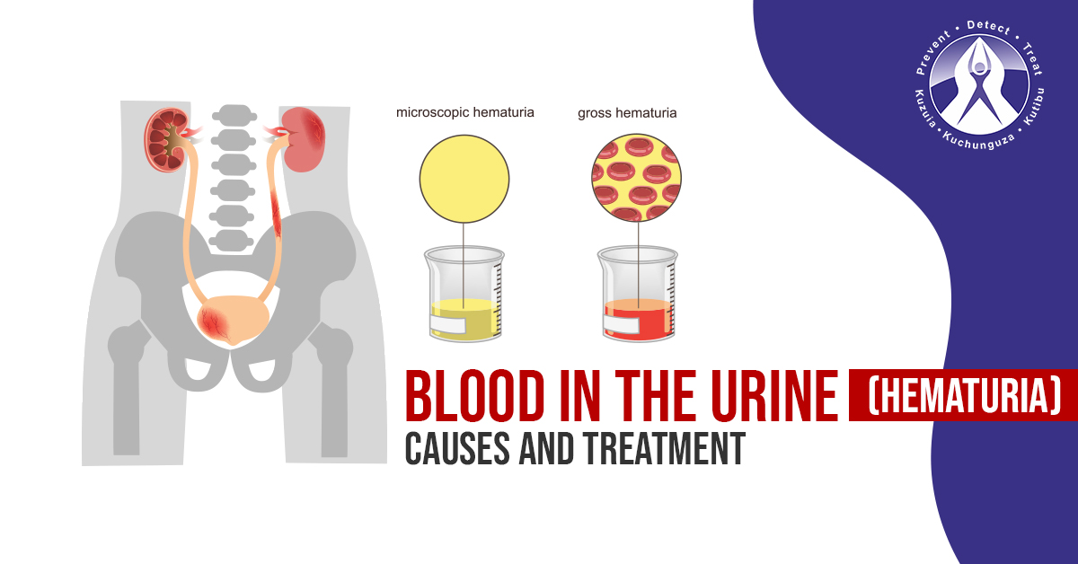 Blood-in-the-Urine-Hematuria