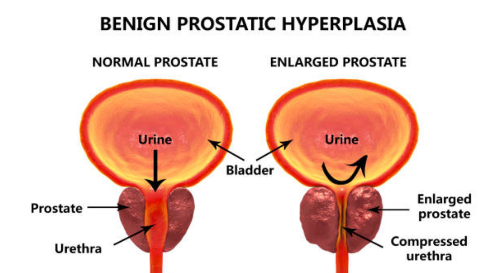Benign-enlargement-of-the-prostate