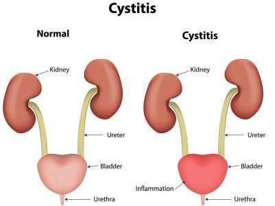 Inflammation-urinary-system