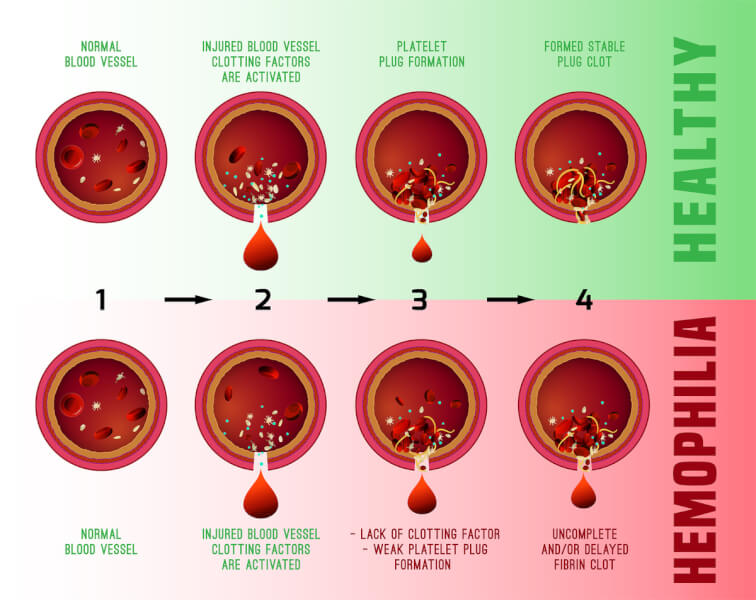 Blood In The Urine Hematuria Causes And Treatment Regency Hospital