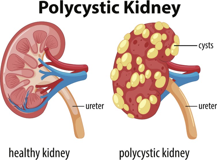 Polycystic-kidney-diseases