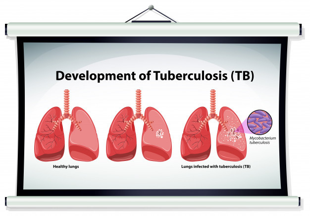 What is Tuberculosis