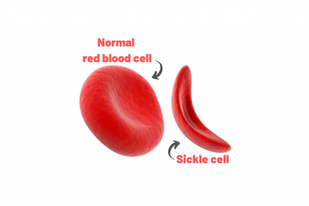 Normal red blood cell vs sickle cell