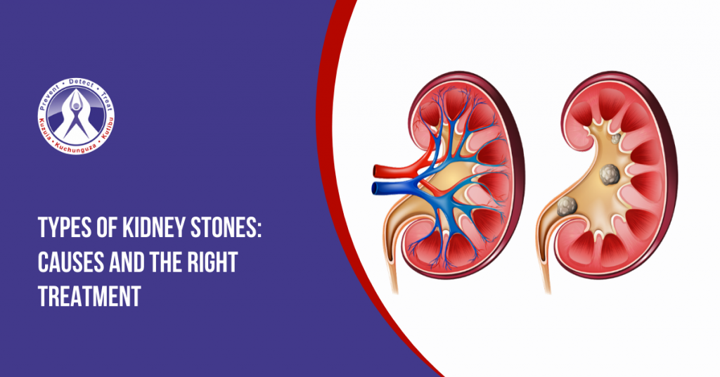 Kidney Stones Types, Causes & The Right Treatment Regency Hospital