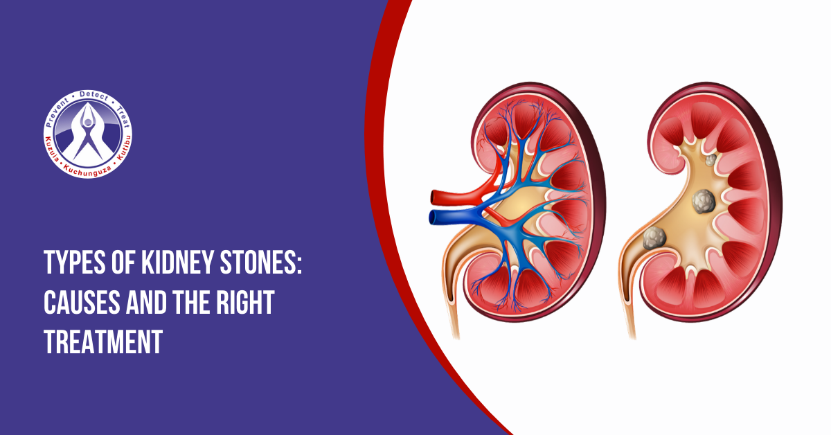 Types of Kidney Stones