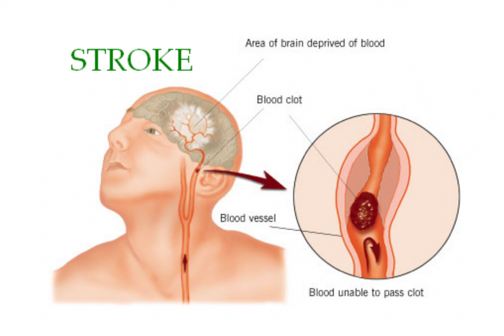 Transient Ischemic Attack