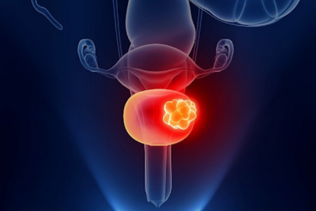 bladder cancer symptoms