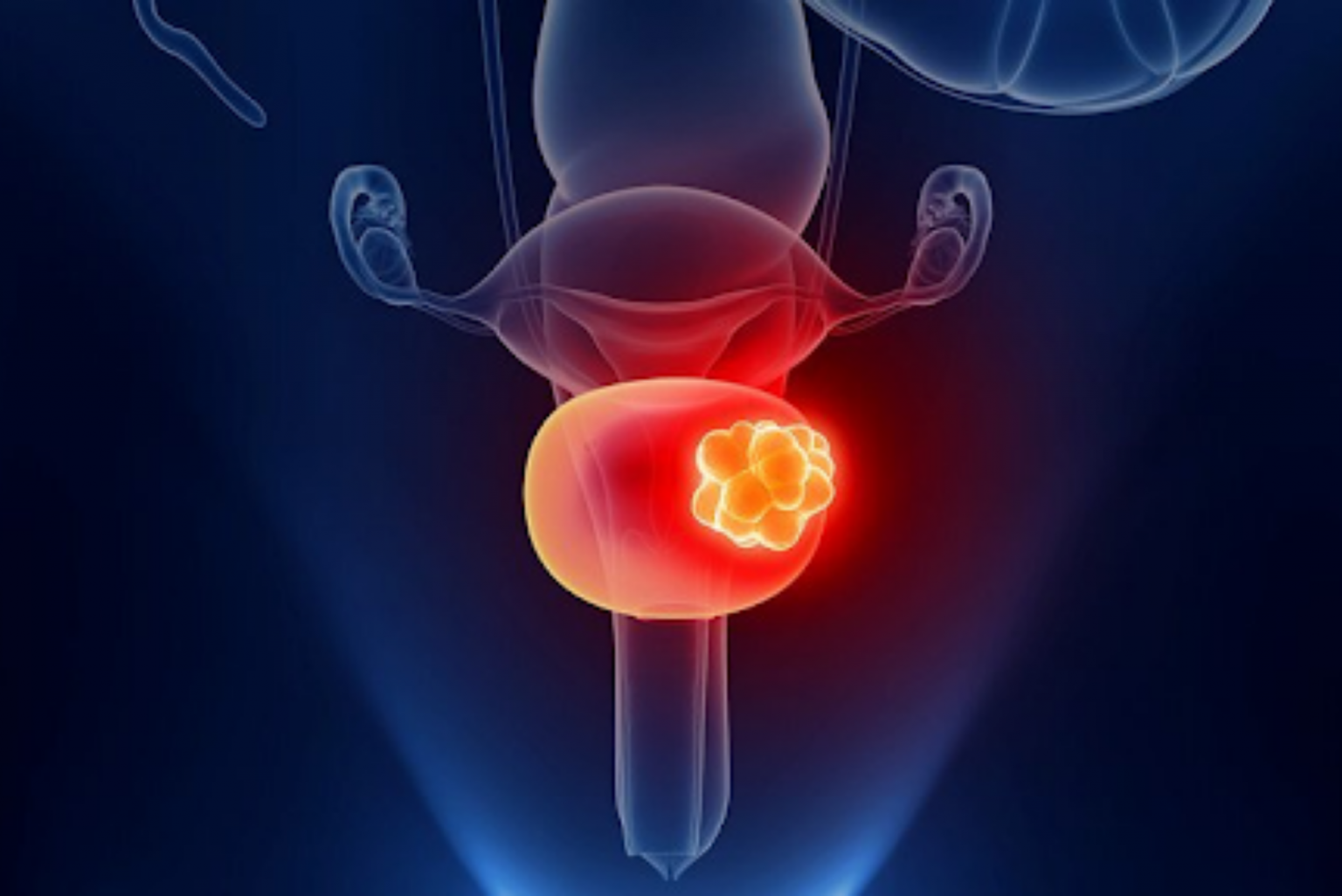 Bladder Cancer: Types Causes The Right Treatment Regency Hospital