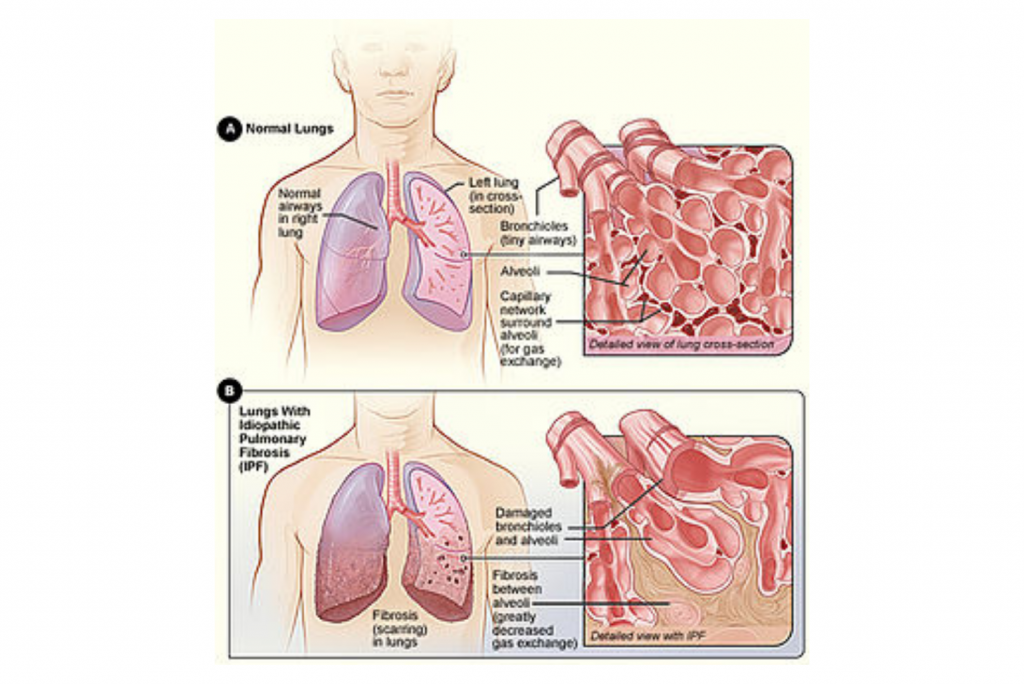 Idiopathic pulmonary fibrosis