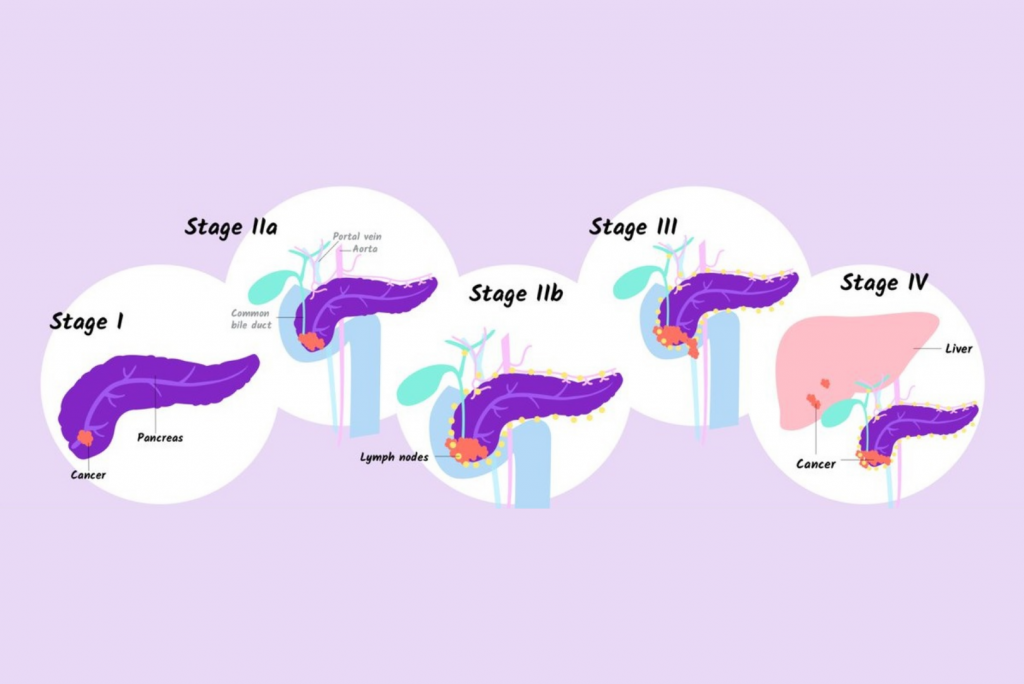 Pancreatic Neuroendocrine Tumors