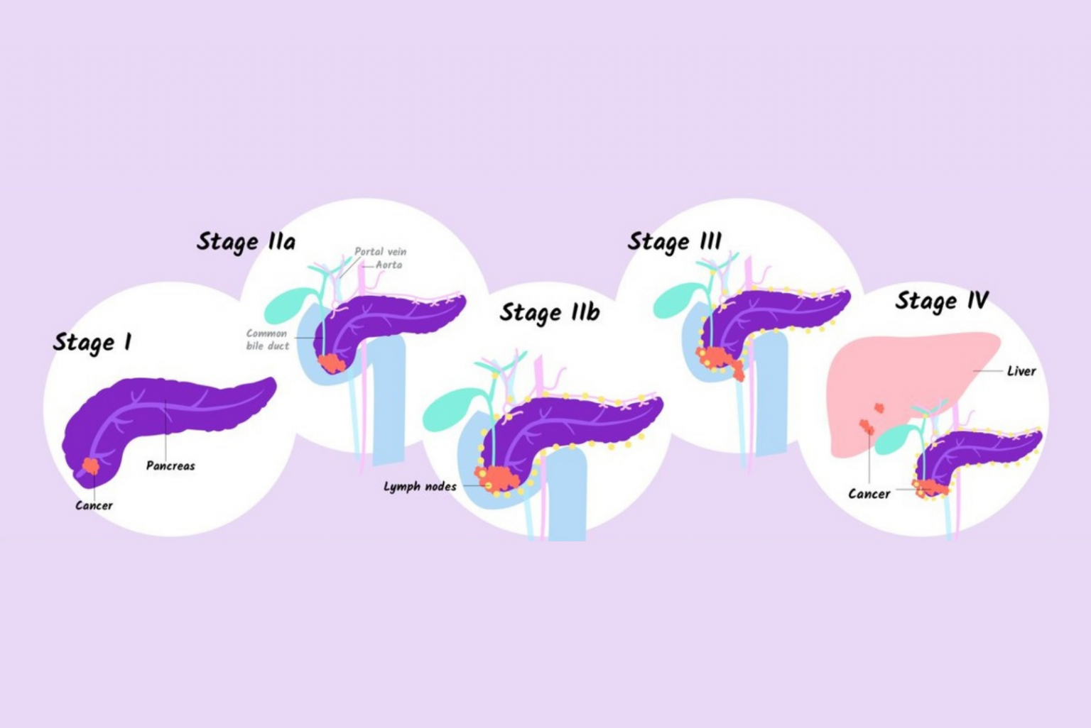 Pancreatic Cancer Symptoms, Types, Causes & Treatment