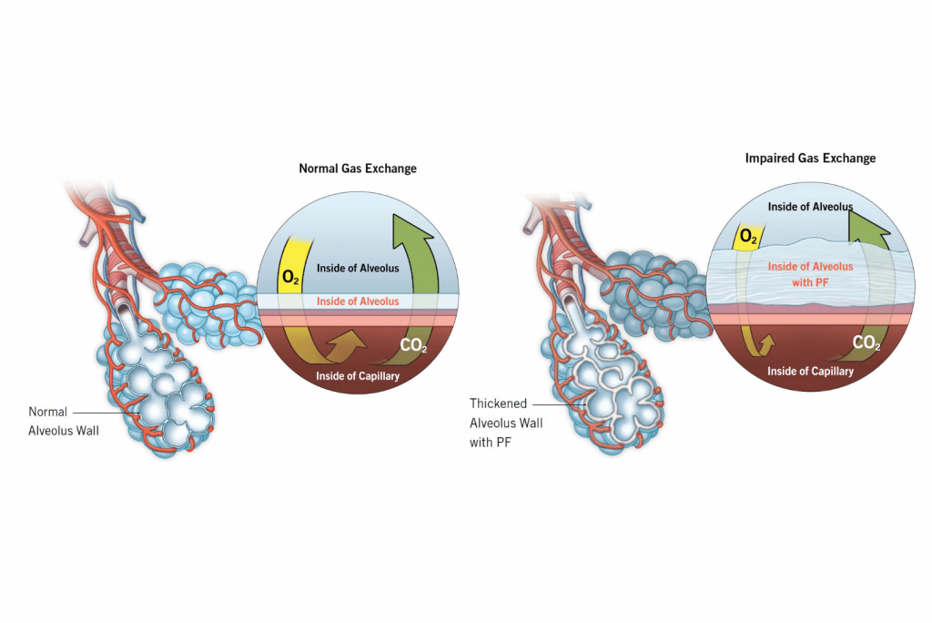 Pulmonary fibrosis