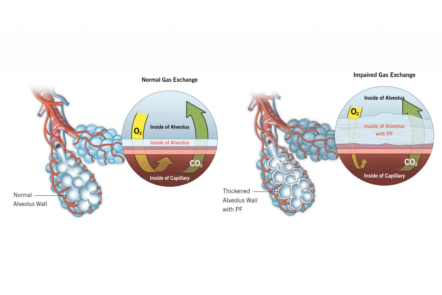 Pulmonary Fibrosis Symptoms, Diagnosis, and Treatment