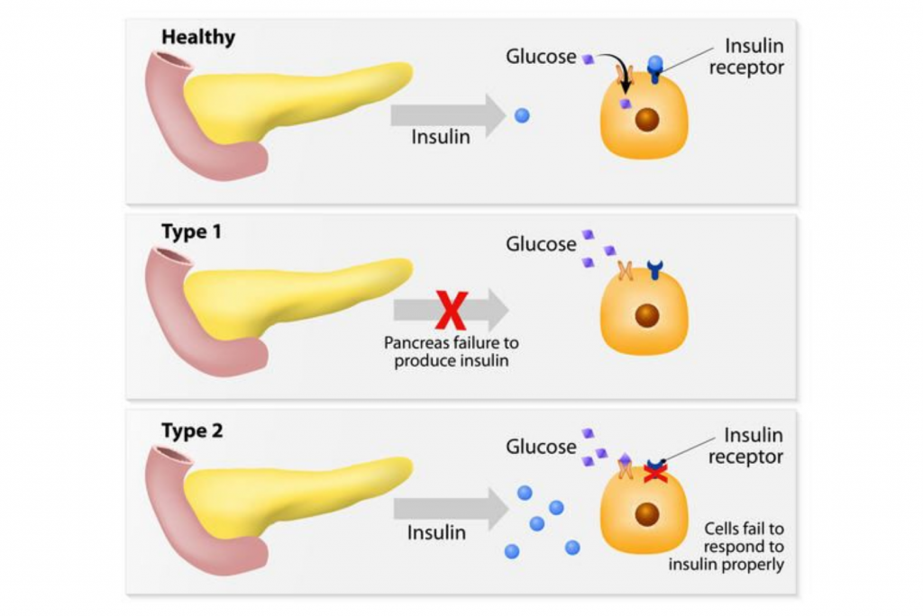 causes of diabetes