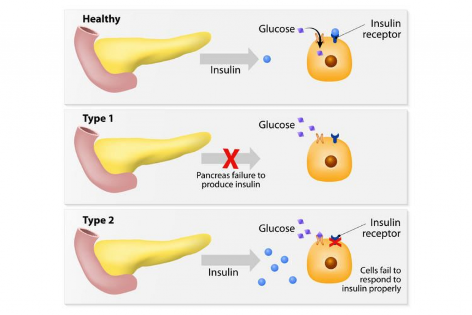 Ejercicio en ayunas diabetes