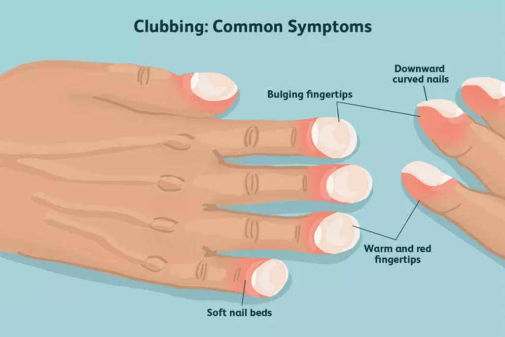 clubbing common symptoms