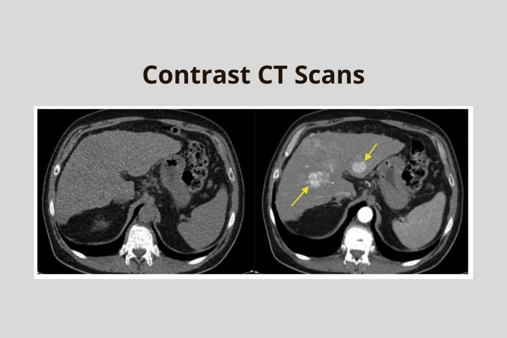 Contrast CT Scans