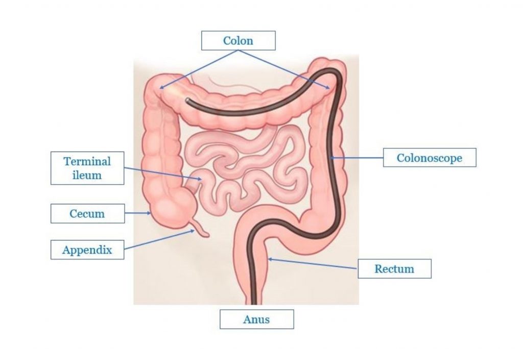 colonoscopy