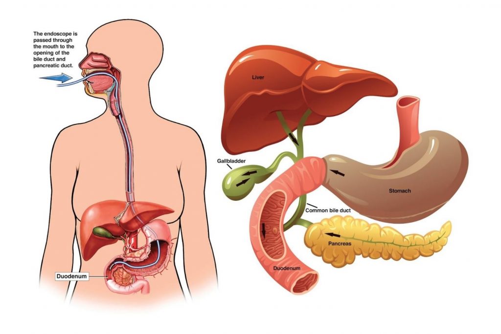 Endoscopic Retrograde CholangioPancreatography ERCP