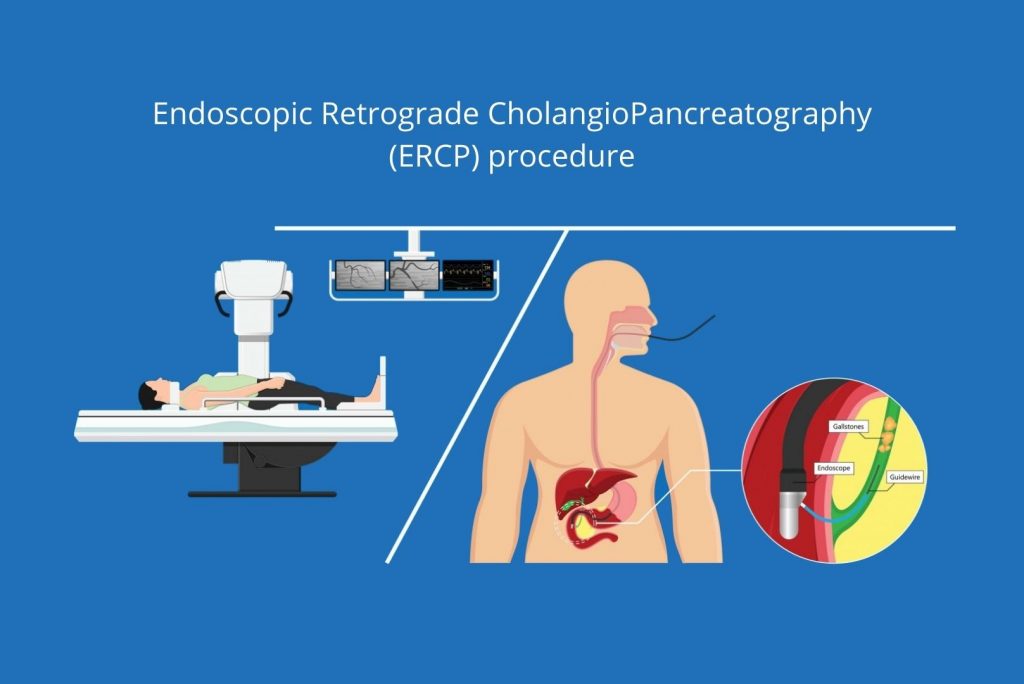 Endoscopic Retrograde CholangioPancreatography ERCP procedure