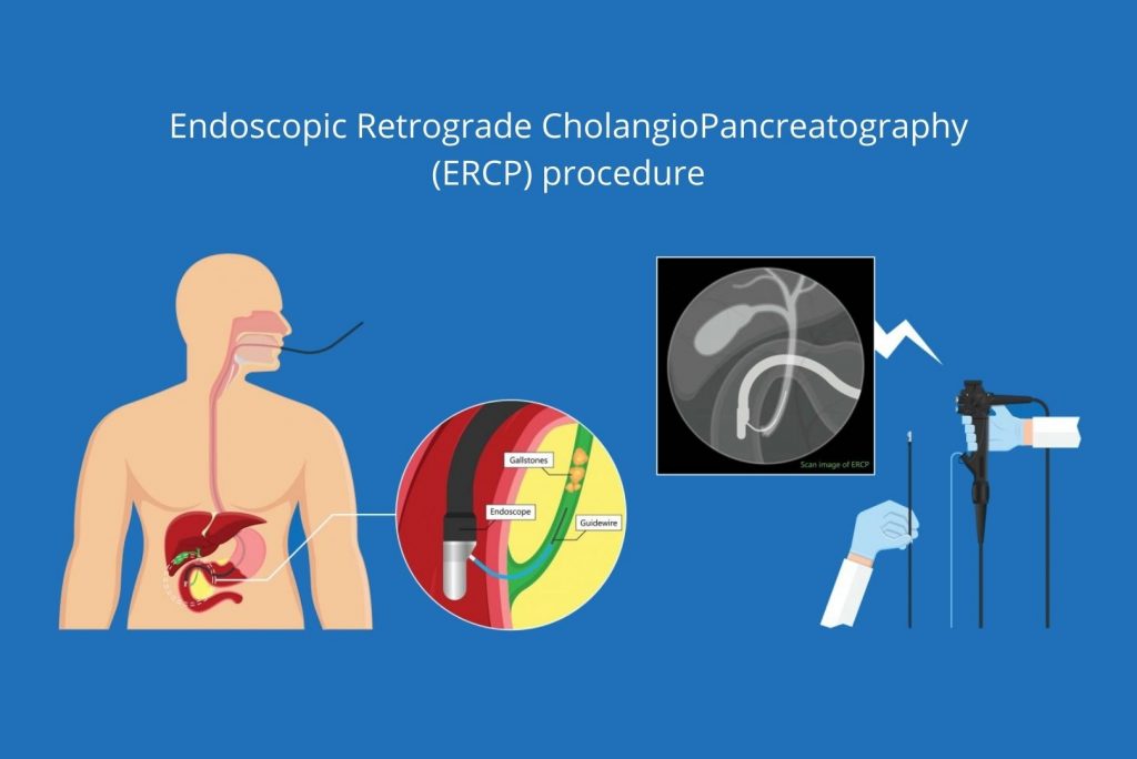Endoscopic Retrograde CholangioPancreatography ERCP procedure