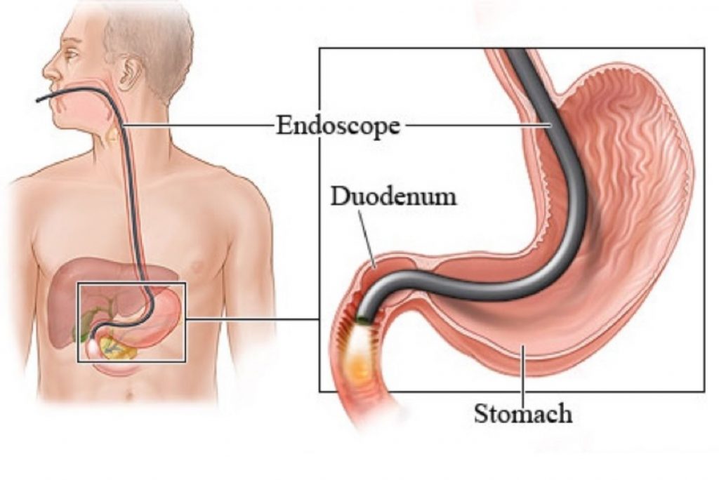 upper GI endoscopy