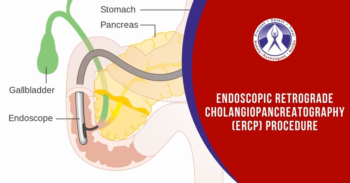 Endoscopic Retrograde CholangioPancreatography (ERCP) procedure