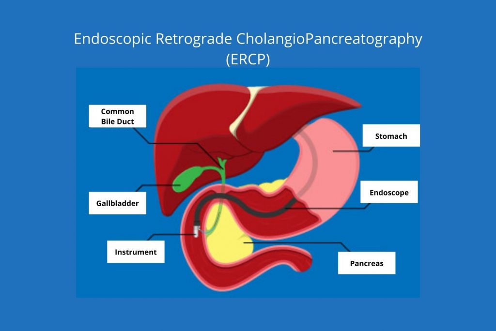 Endoscopic Retrograde CholangioPancreatography ERCP