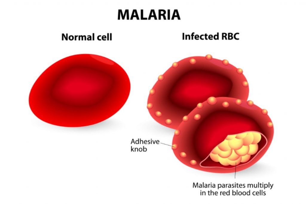 Malaria Diagnosed