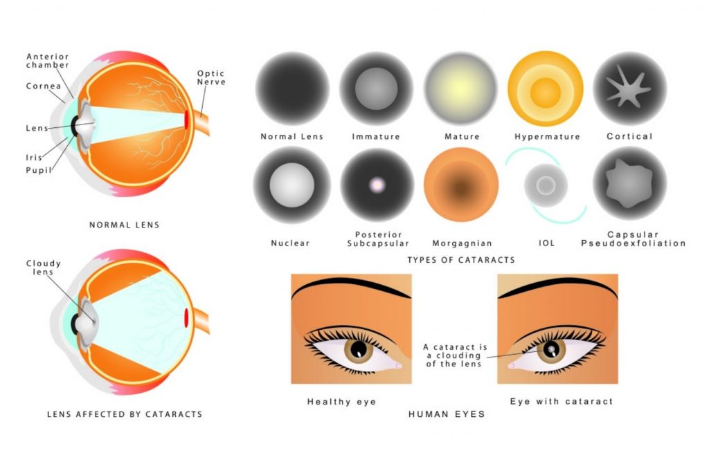 Types of cataract