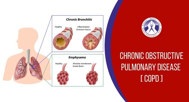 Chronic Obstructive Pulmonary Disease