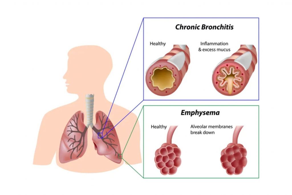 what is Chronic Obstructive Pulmonary Disease - COPD