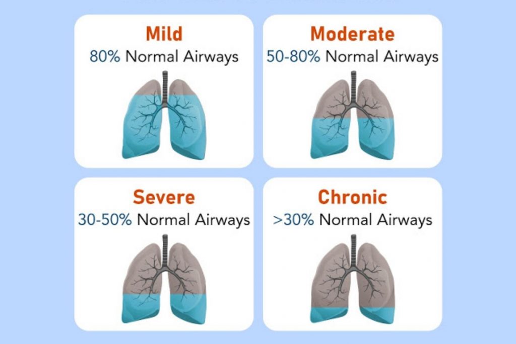 Stages of Chronic Obstructive Pulmonary Disease