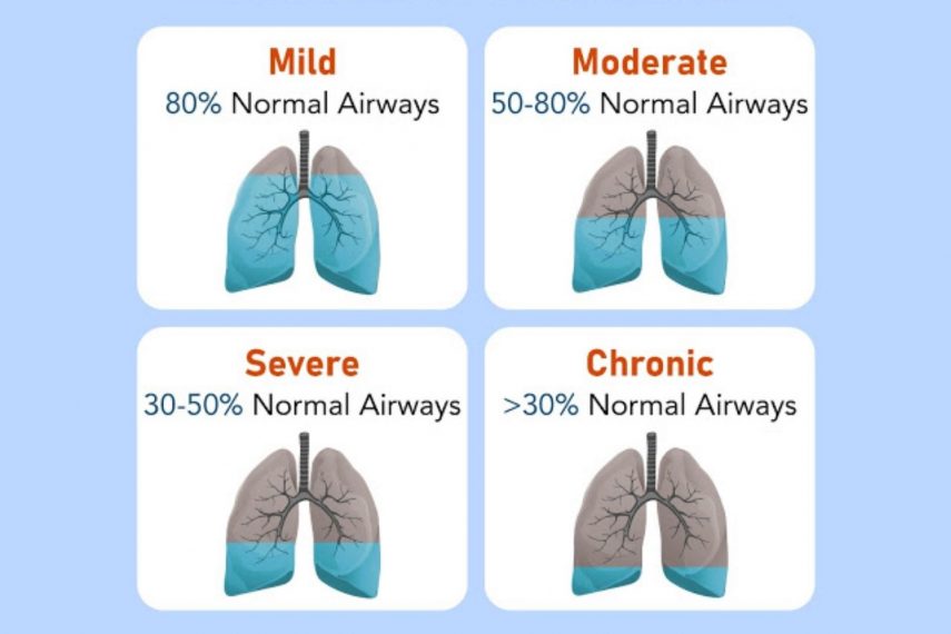 AN INFORMATION GUIDE TO CHRONIC OBSTRUCTIVE PULMONARY DISEASE AN INFORMATION GUIDE TO CHRONIC OBSTRUCTIVE PULMONARY DISEASE
