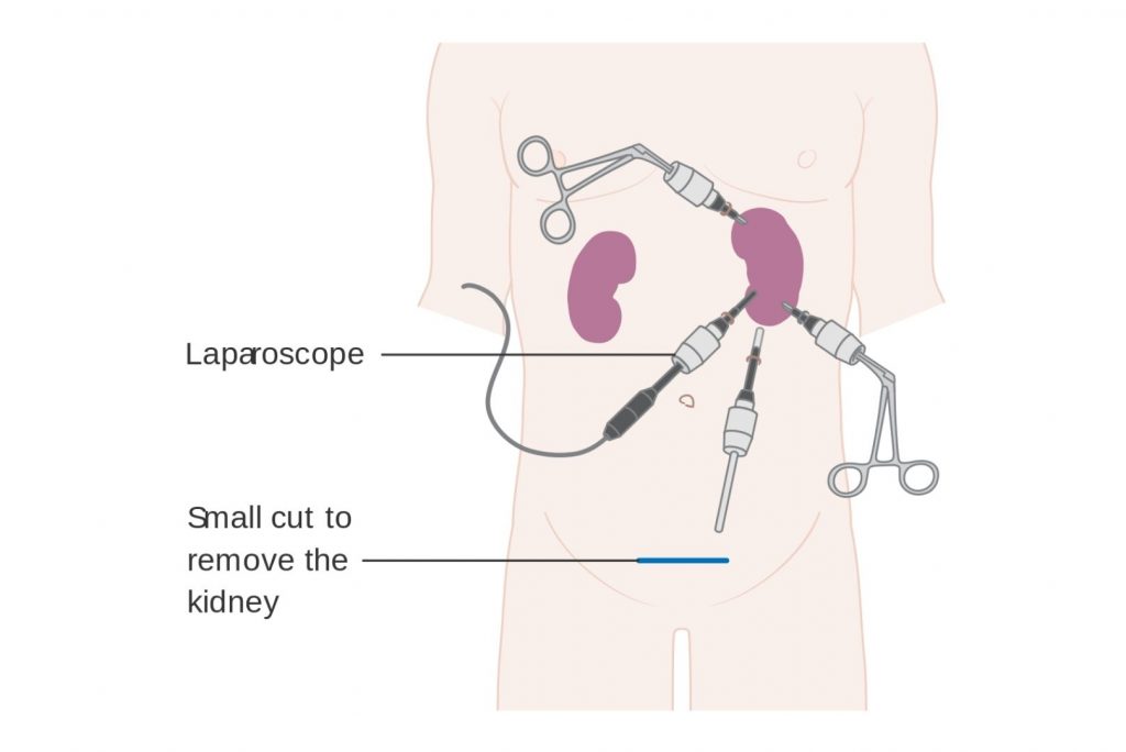 Laparoscopy Surgery